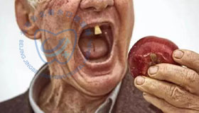 全口缺失牙的综合修复方案 全口缺失牙的综合修复方案